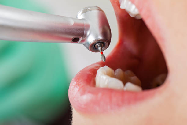 Best Emergency Wisdom Teeth Removal in Chester Center, CT